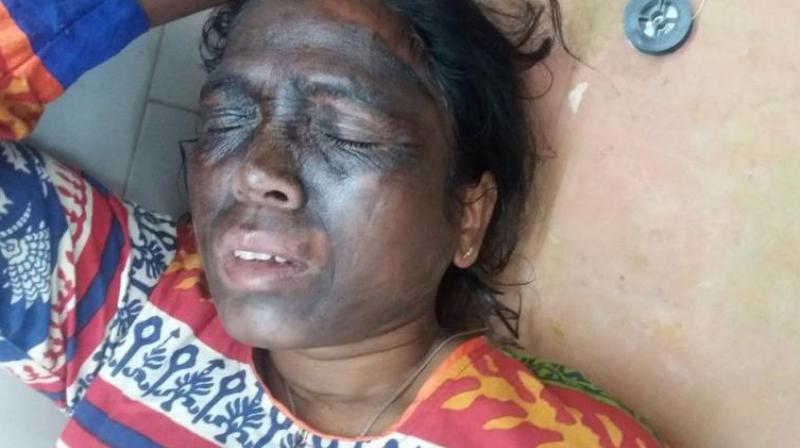 Tribal activist Soni Sori complained of burning sensation in her face after an attack. (Photo: Twitter)