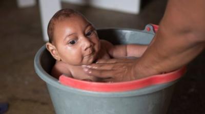 Zika, suspected of causing brain defects in more than 4,000 newborns in Brazil 